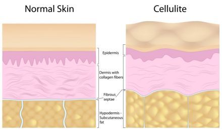 Natural Ways To Get Rid Of Cellulite