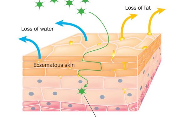 Eczema Explained