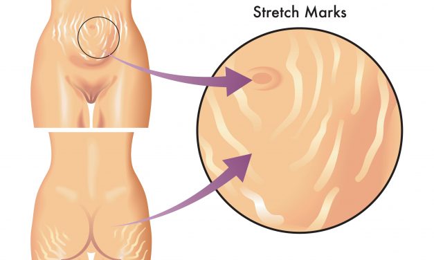 Natural Ways To Get Rid Of Stretch Marks