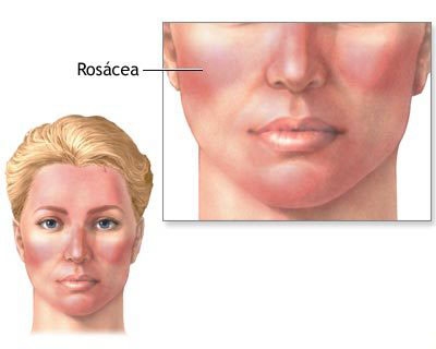 How To Get Rid Of Rosacea